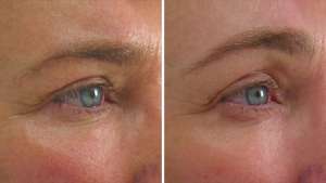 Perawatan ULTHERAPY