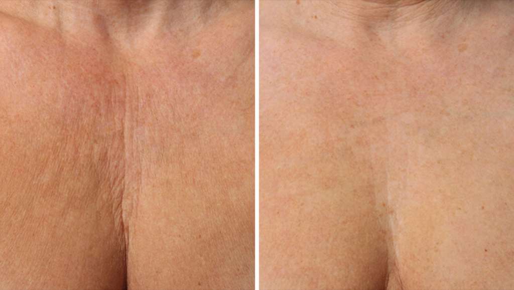 Perawatan ULTHERAPY