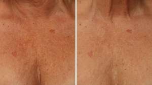 Perawatan ULTHERAPY
