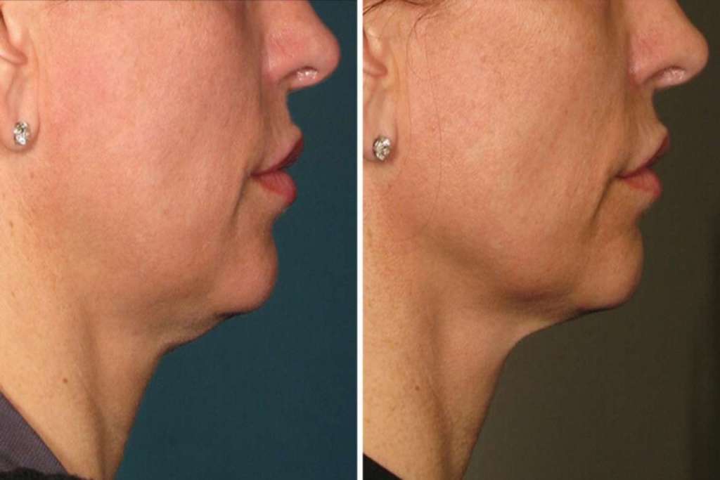 Perawatan ULTHERAPY® (USA), Awet Muda Tanpa Operasi