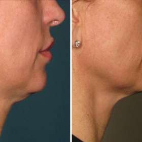 Perawatan ULTHERAPY® (USA), Awet Muda Tanpa Operasi