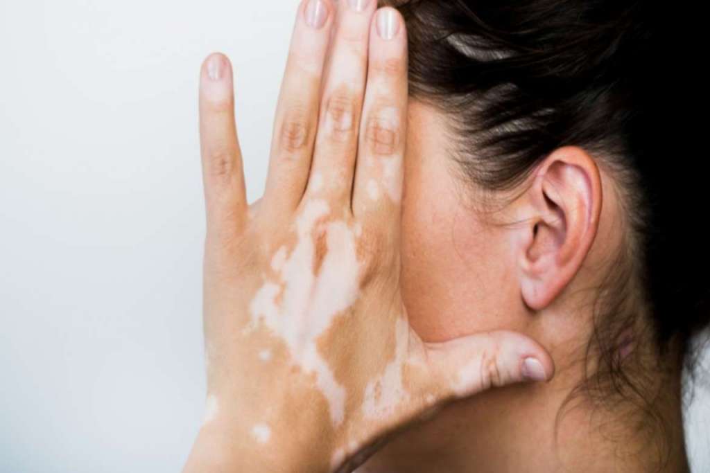 Pilihan Pengobatan Vitiligo dan Perawatan Kulit