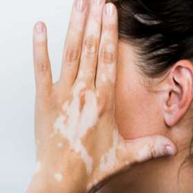 Pilihan Pengobatan Vitiligo dan Perawatan Kulit