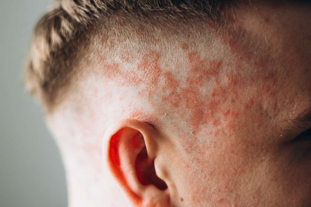 Mengenal Psoriasis: Penyebab, Gejala, dan Pengobatannya