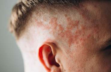 psoriasis adalah