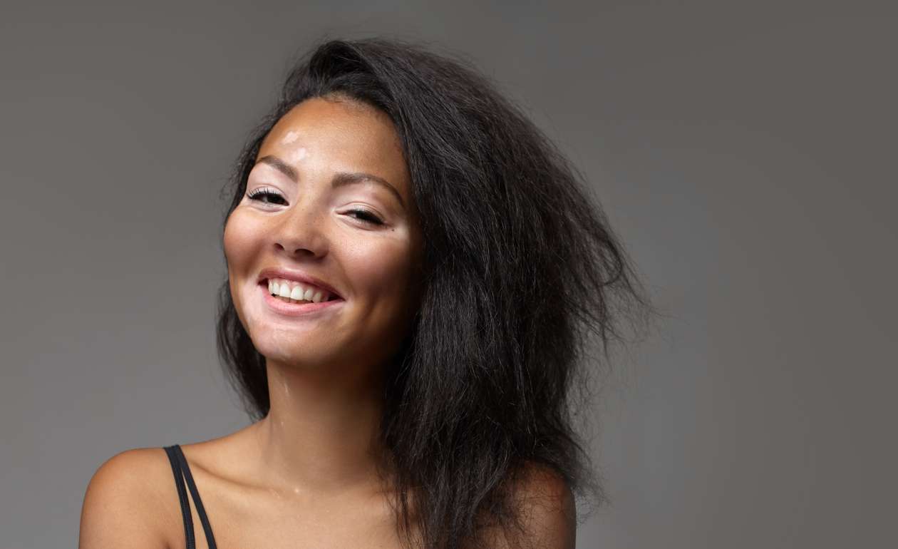 vitiligo adalah