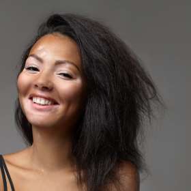 Penyebab Vitiligo, Gejala, dan Cara Tepat Mengatasinya