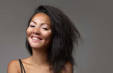 vitiligo adalah