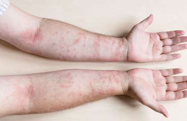 dermatitis kontak