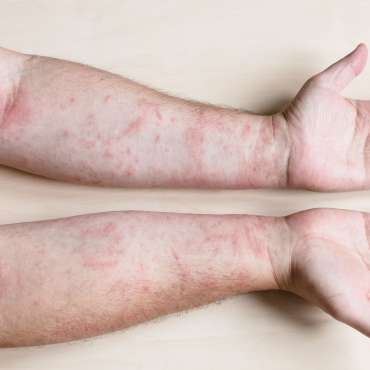 Penyebab Dermatitis Kontak, Gejala, dan Pengobatannya