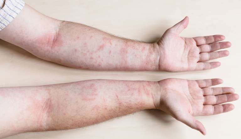 Penyebab Dermatitis Kontak, Gejala, dan Pengobatannya