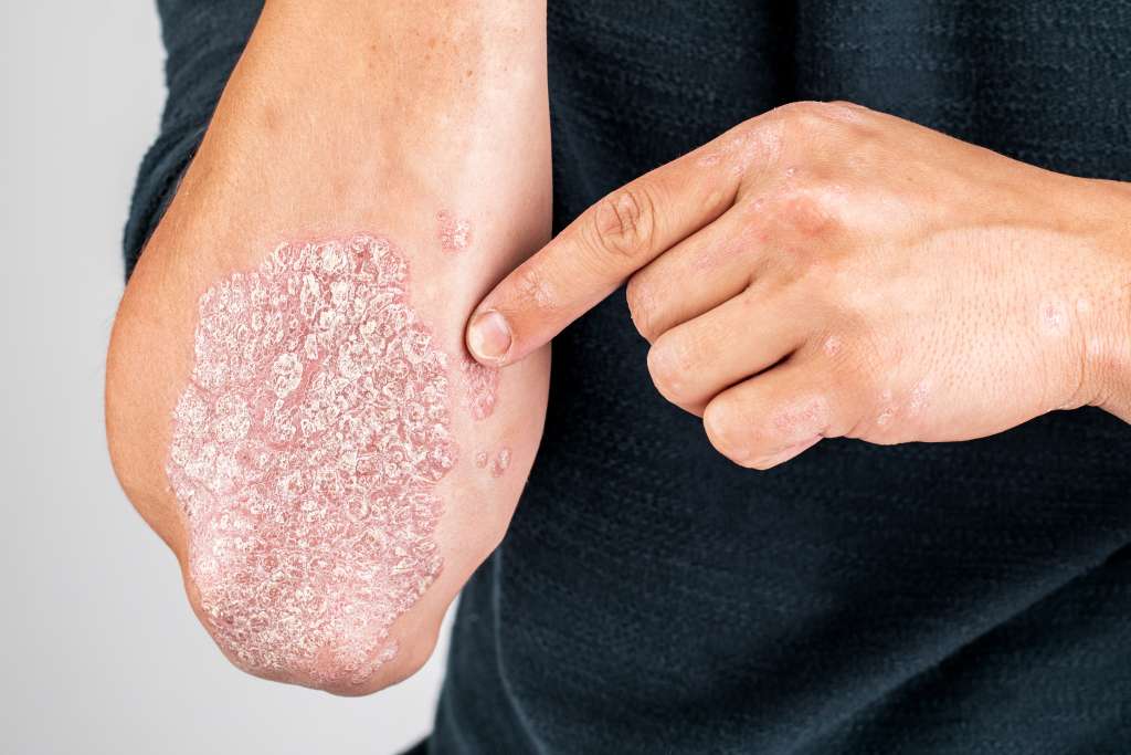Mengenal 8 Jenis Psoriasis pada Kulit dan Gejalanya