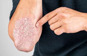 Jenis Psoriasis