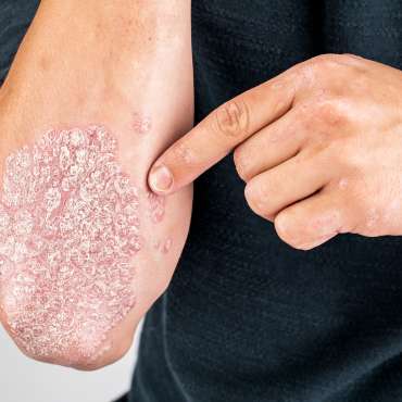 Mengenal 8 Jenis Psoriasis pada Kulit dan Gejalanya