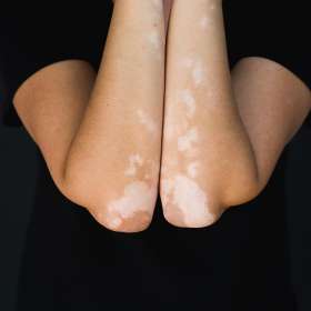Pengobatan Vitiligo dengan Laser 311nm Saphire Laser (Pallas®)