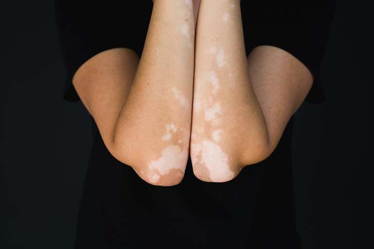 Pengobatan Vitiligo dengan Laser 311nm Saphire Laser (Pallas®)