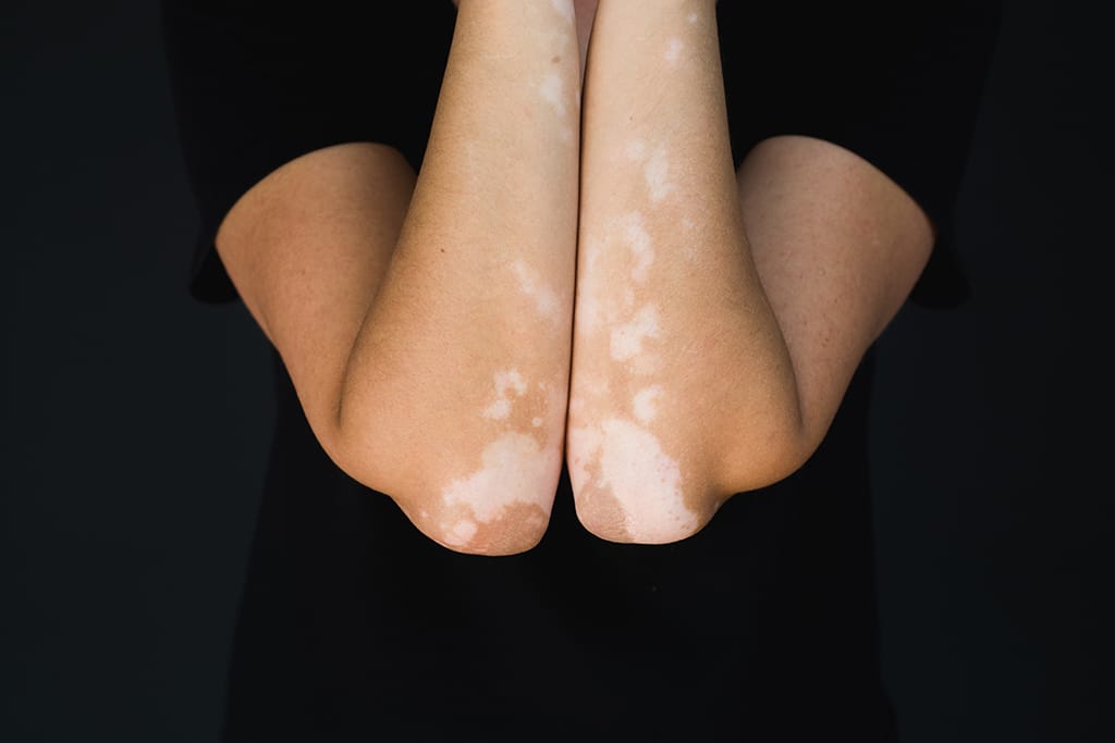Pengobatan Vitiligo dengan Laser 311nm Saphire Laser (Pallas®)
