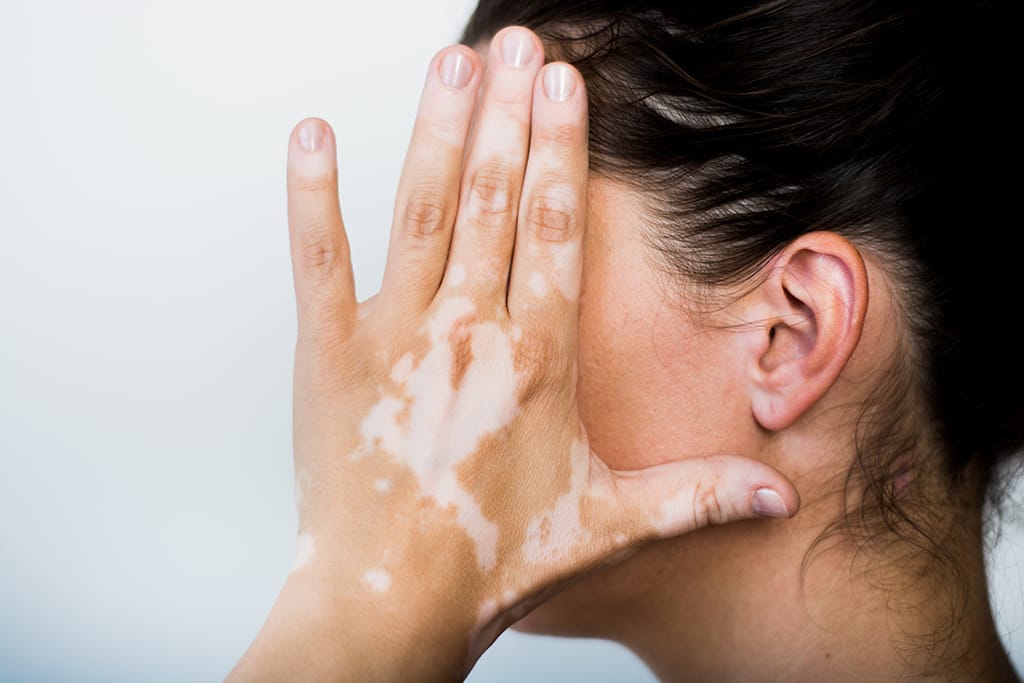 Pengobatan  Vitiligo 