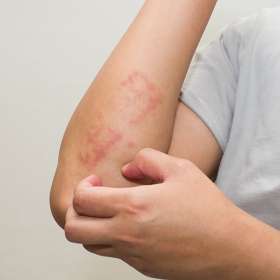 Perbedaan Dermatitis Seboroik dan Psoriasis!
