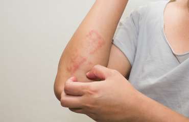 perbedaan dermatitis seboroik dan psoriasis