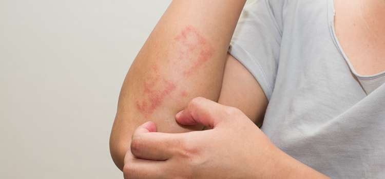 perbedaan dermatitis seboroik dan psoriasis