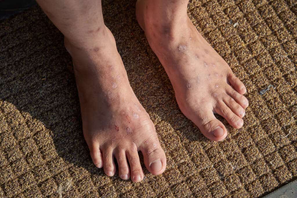 Cara Mengobati Eksim di Kaki yang Cepat dan Efektif