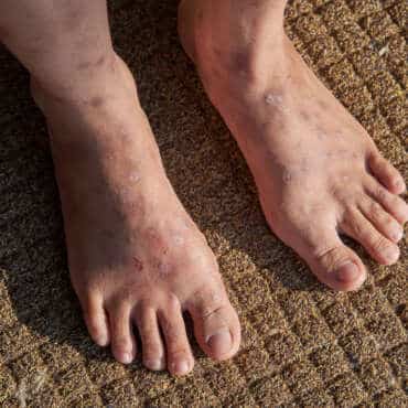 Cara Mengobati Eksim di Kaki yang Cepat dan Efektif
