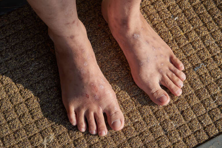 Cara Mengobati Eksim di Kaki yang Cepat dan Efektif