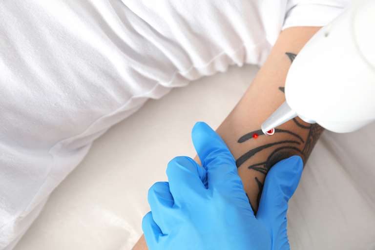 Mudah! Ini Dia Cara Menghapus Tato Permanen