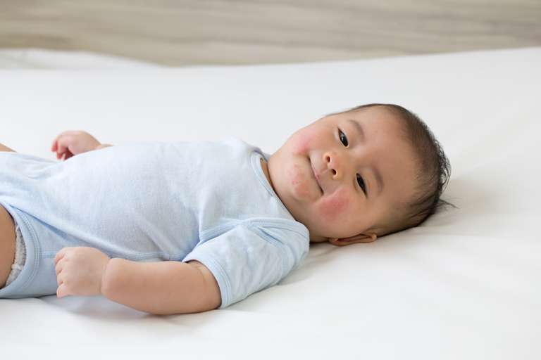 Jerawat pada Bayi