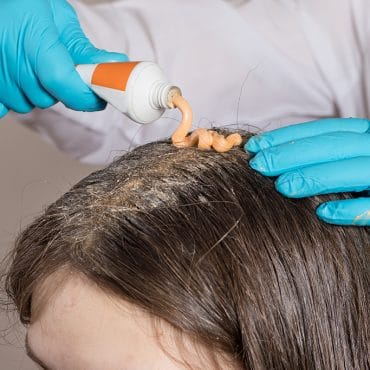 Psoriasis Kulit Kepala: Penyebab dan Cara Mengatasinya!