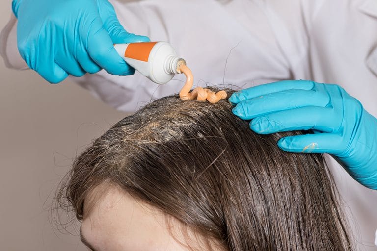 Psoriasis Kulit Kepala: Penyebab dan Cara Mengatasinya!