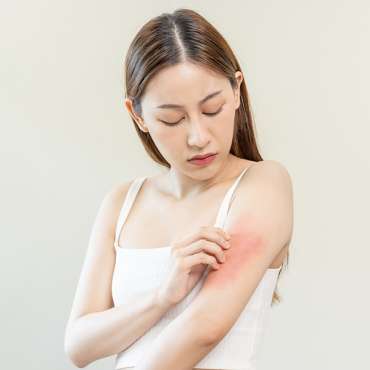 Dermatitis Kontak Alergi: Penyabab hingga Cara Mengatasi