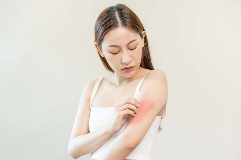 Dermatitis Kontak Alergi: Penyabab hingga Cara Mengatasi