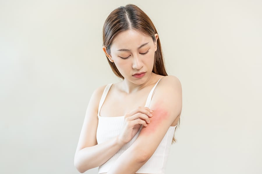 dermatitis kontak alergi