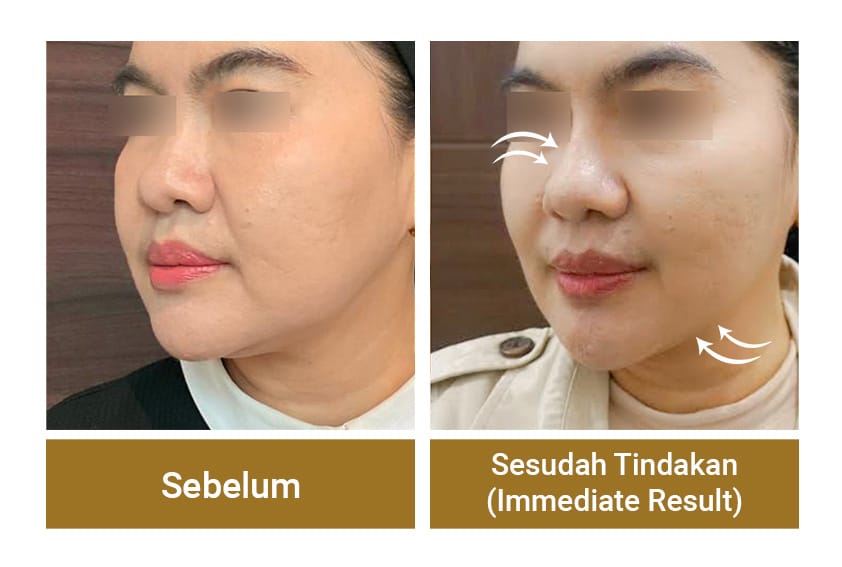 thread lift