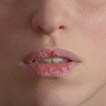 6 Penyebab Bibir Kering dan Hitam Beserta Cara Mengatasinya