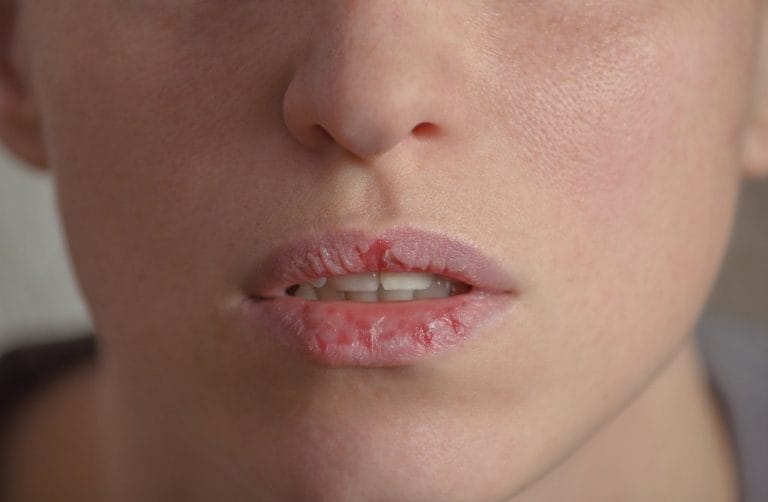 6 Penyebab Bibir Kering dan Hitam Beserta Cara Mengatasinya