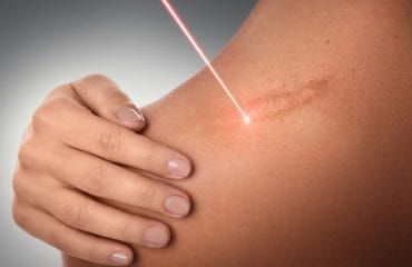 10 Cara Mengatasi Bekas Luka dengan Mudah dan Ampuh