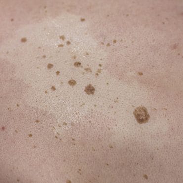 Mengenal Keratosis Seboroik: Gejala dan Penyebabnya