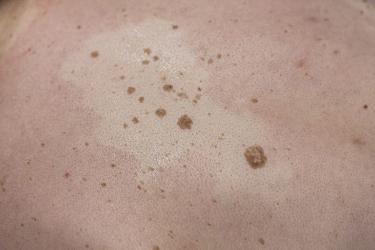 Mengenal Keratosis Seboroik: Gejala dan Penyebabnya