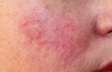 Telangiektasis pada Wajah, Garis-garis Merah Seperti Sarang Laba-laba