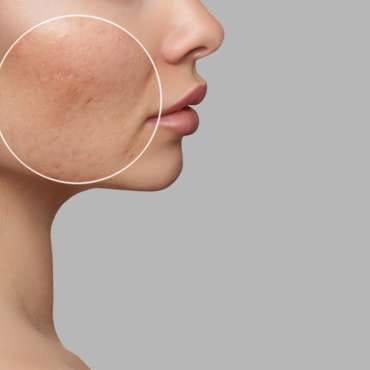 6 Cara Cepat Menghilangkan Bopeng (Scars) dengan Tindakan Medis