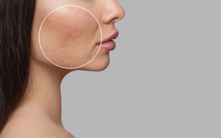 6 Cara Cepat Menghilangkan Bopeng (Scars) dengan Tindakan Medis