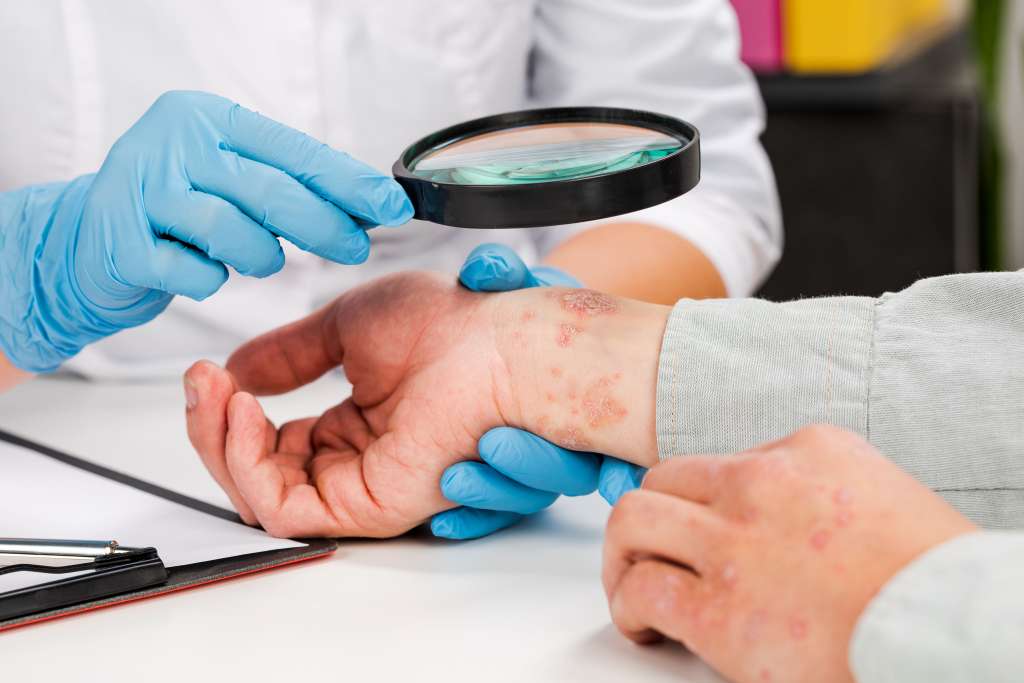 Apakah Psoriasis Bisa Sembuh? Cek dengan Dokter Spesialis