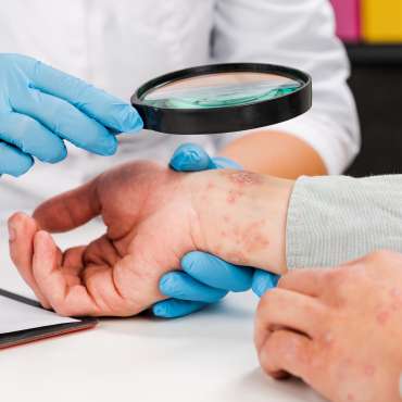 Apakah Psoriasis Bisa Sembuh? Cek dengan Dokter Spesialis