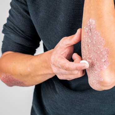 Ragam Pengobatan Psoriasis dan Perawatan Alami di Rumah