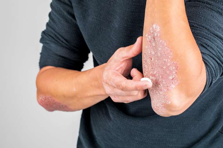 Ragam Pengobatan Psoriasis dan Perawatan Alami di Rumah
