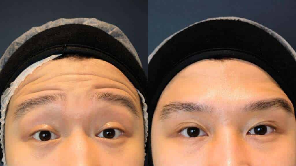 Before After Botox Before After Botox