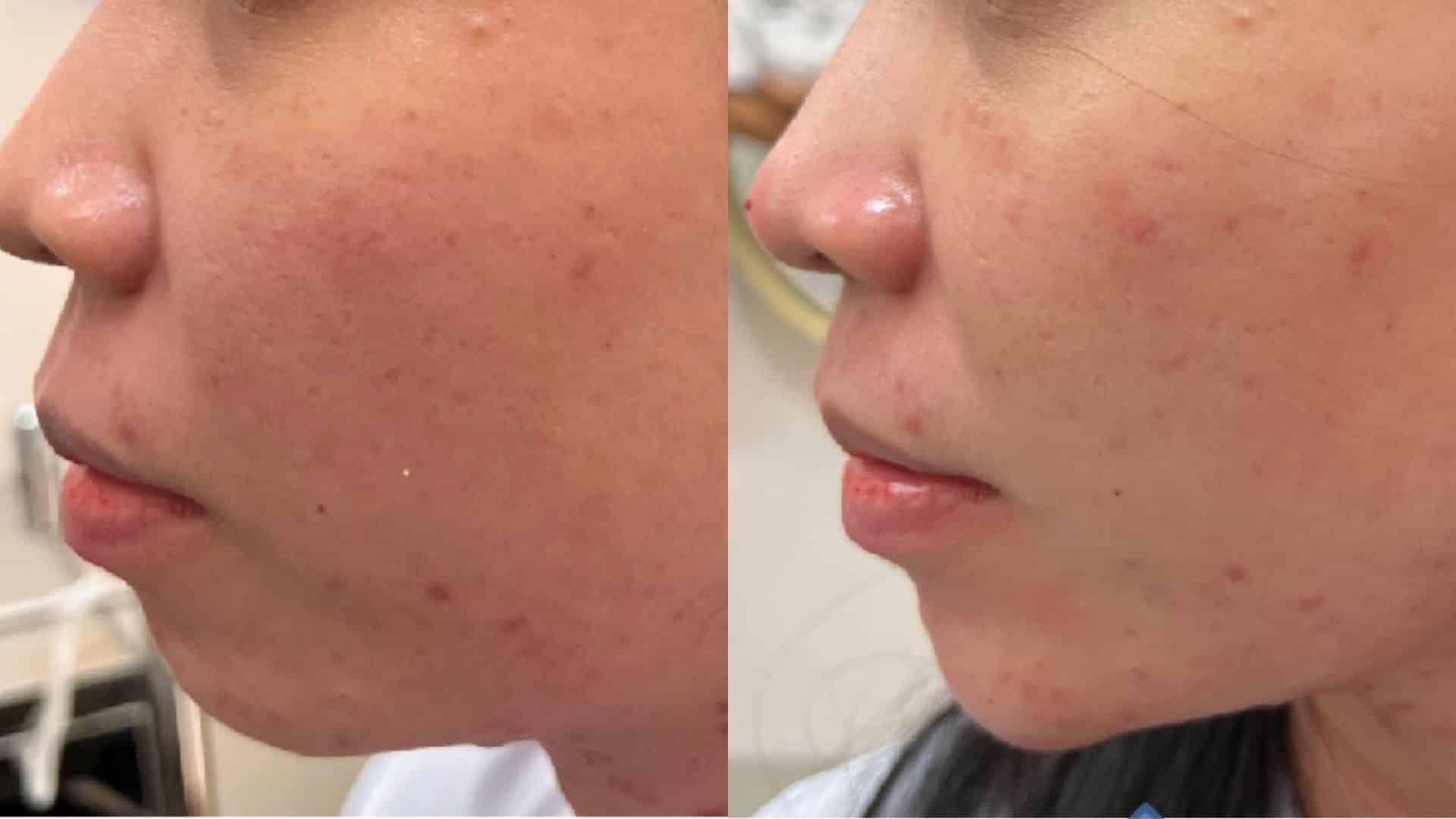 Before After Filler before after filler